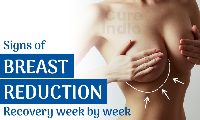 Signs of breast reduction recovery week by week